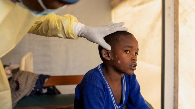 Variole du singe : 28 cas confirmés en Côte d&rsquo;Ivoire